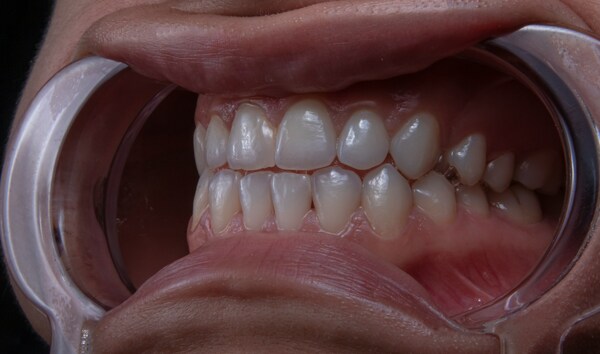 Этапы имплантации передних зубов